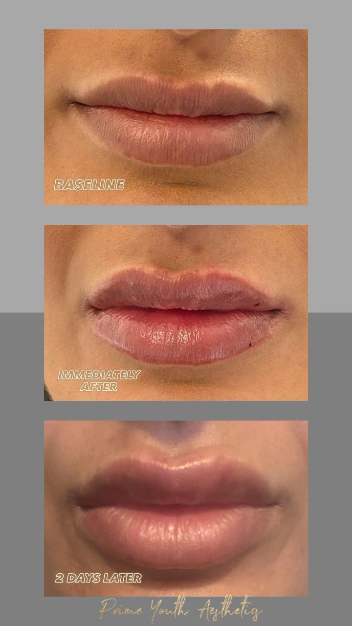 A before and after photo of a woman 's lips.