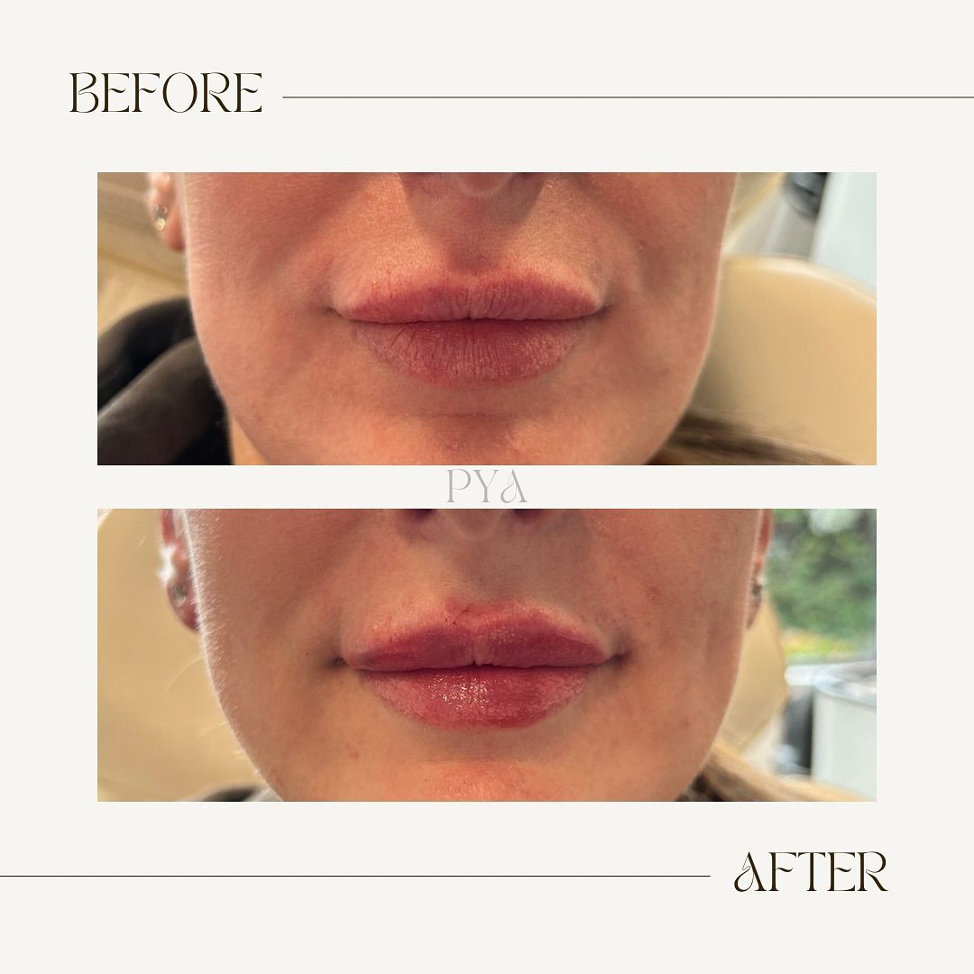 A before and after photo of a woman 's lips.