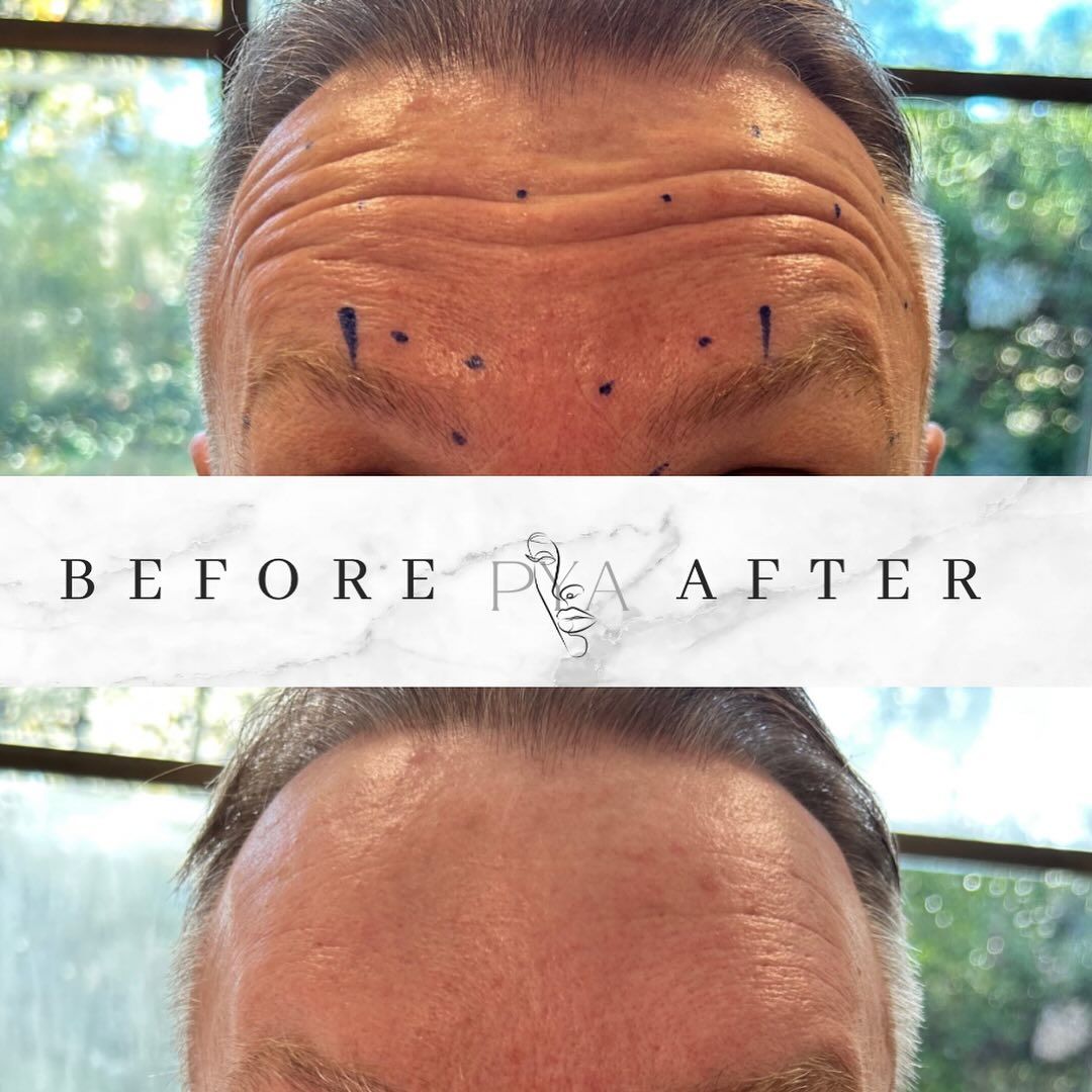 A before and after photo of a man 's forehead