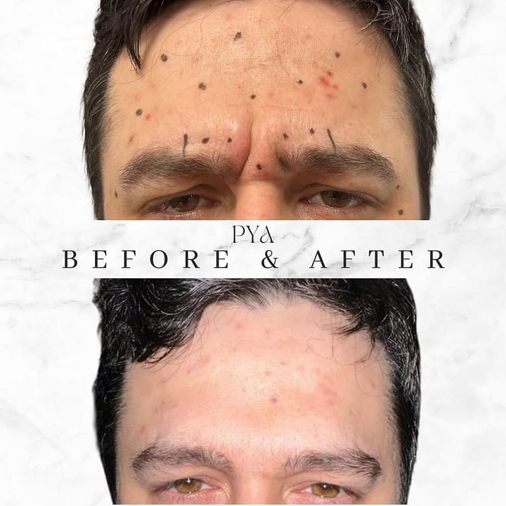 A man 's forehead before and after botox injections.