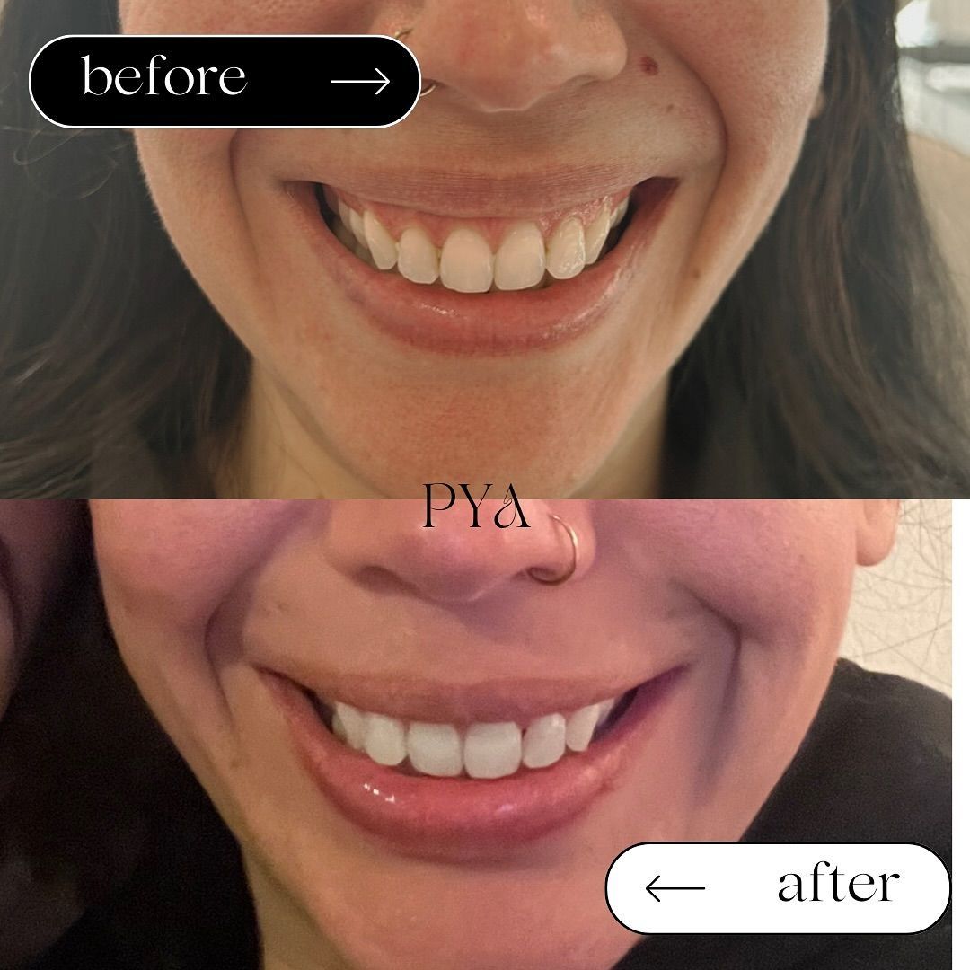 A before and after photo of a woman 's smile