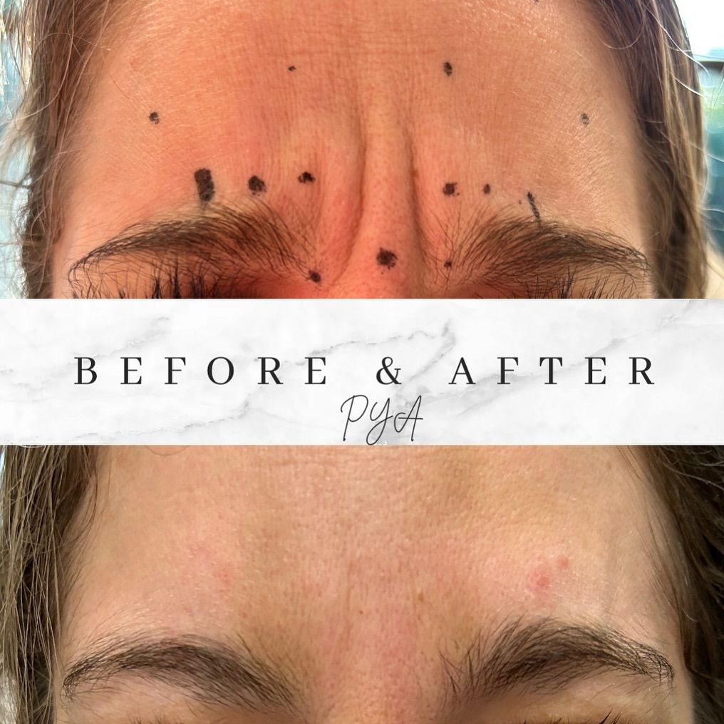 A woman 's forehead before and after botox injections.