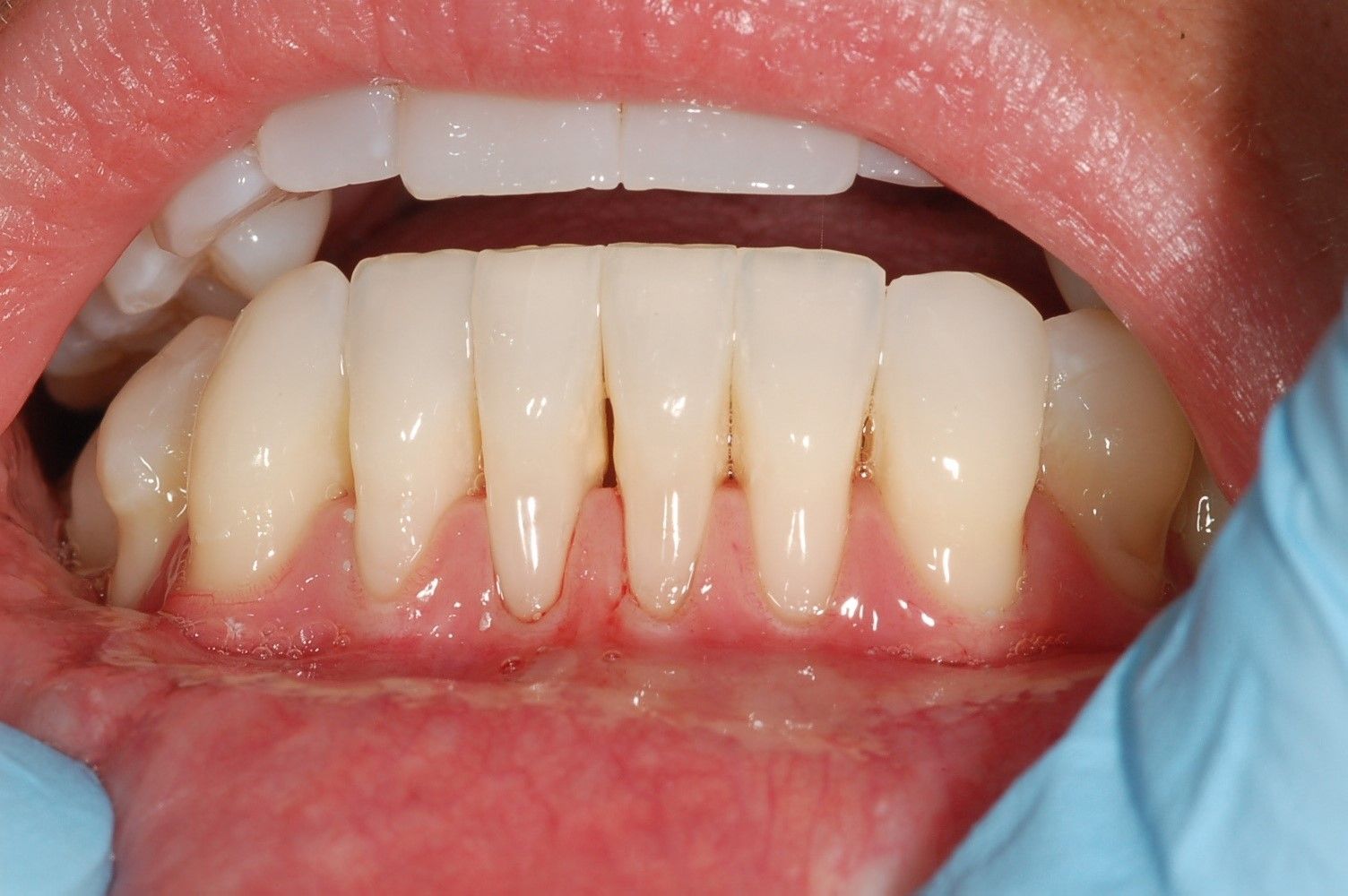 A close up of a person 's teeth with blue gloves on.