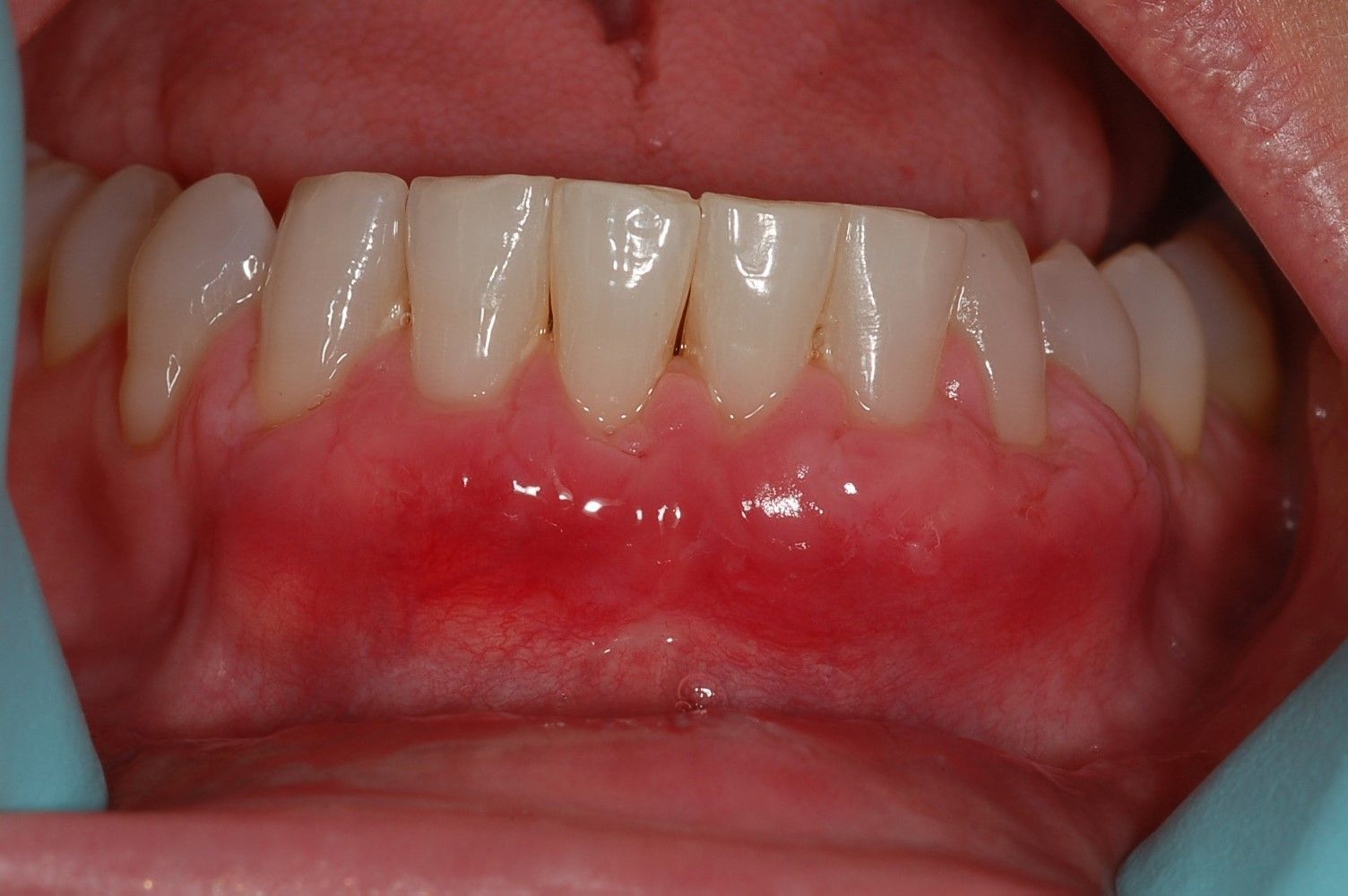 A close up of a person 's mouth with white teeth and red gums.