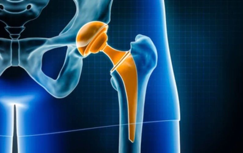 Hip Replacement Specialist | David Agolley Orthopaedic Surgeon