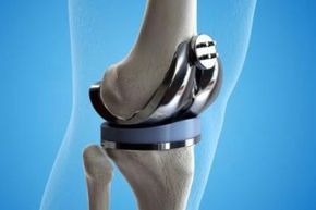 Knee Replacement | David Agolley Orthopaedic Surgeon