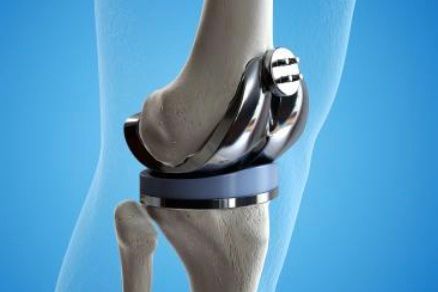 Knee Replacement | David Agolley Orthopaedic Surgeon