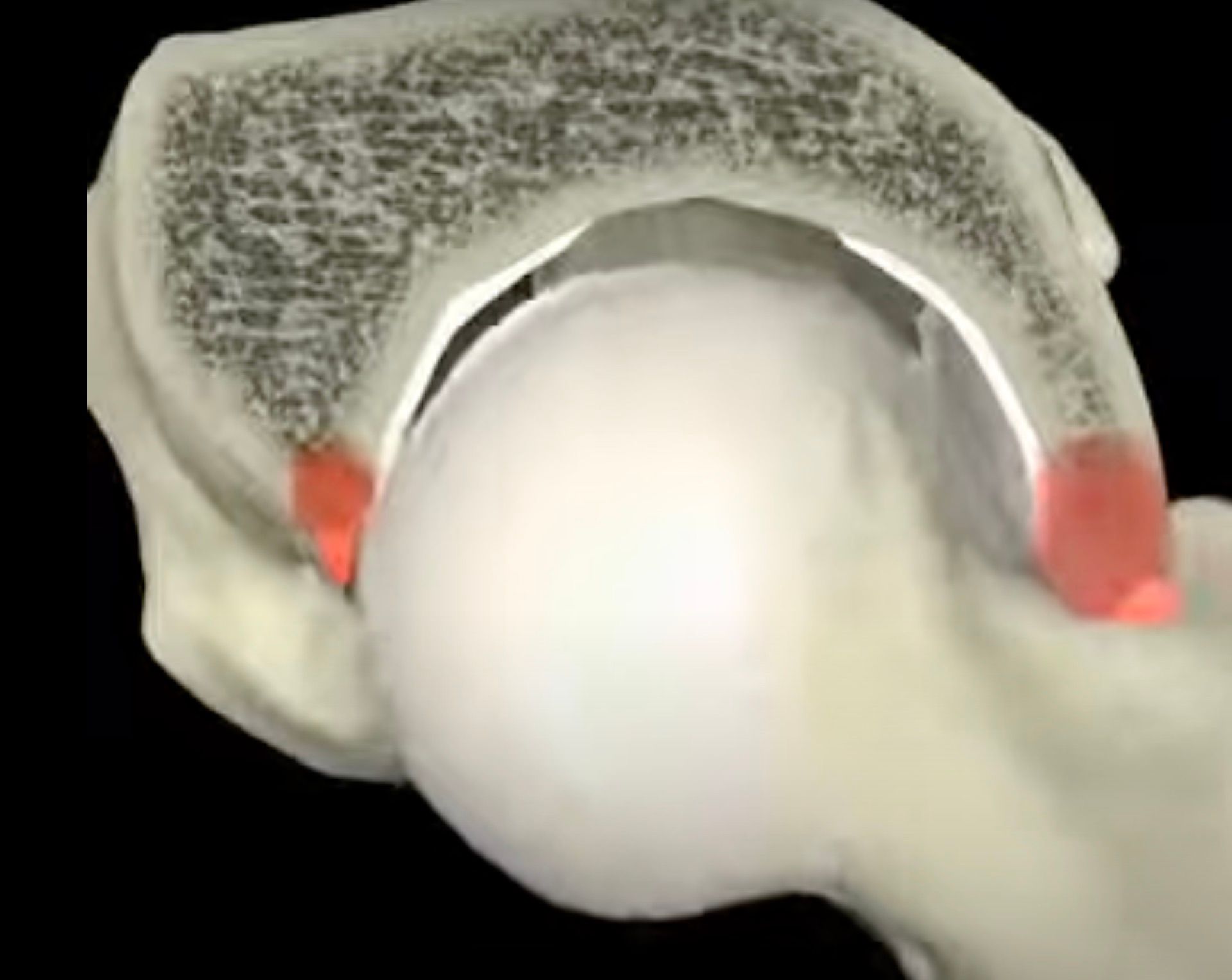 Hip Arthroscopy Surgeon In Southport | David Agolley Orthopaedic Surgeon