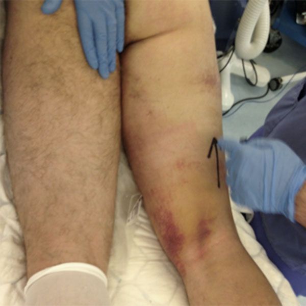 Hip Hamstring Tendon Tear 2 | Dr David Agolley Orthopaedic Surgeon