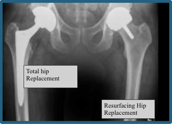 Total Hip Replacement (Right) and Hip Resurfacing (Left) | David Agolley Orthopaedic Surgeon