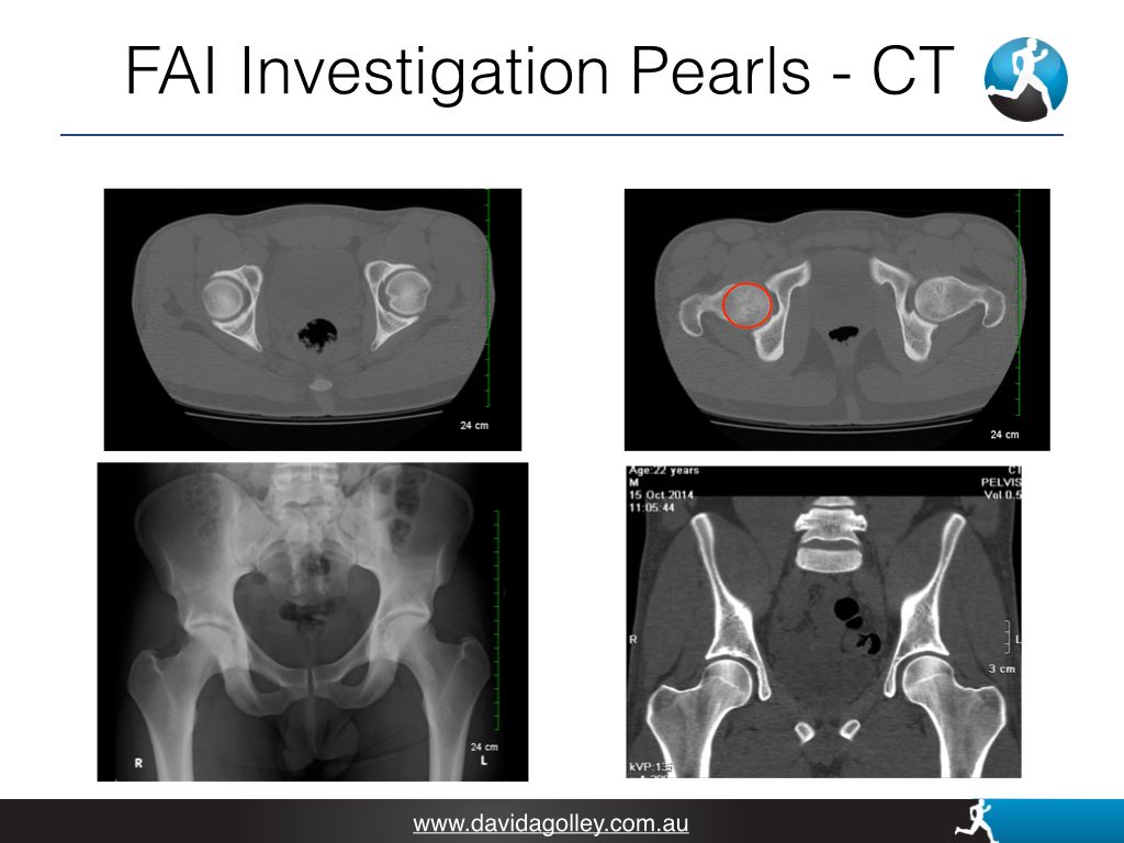 FAI Investigation Pearls - CT | David Agolley Orthopaedic Surgeon