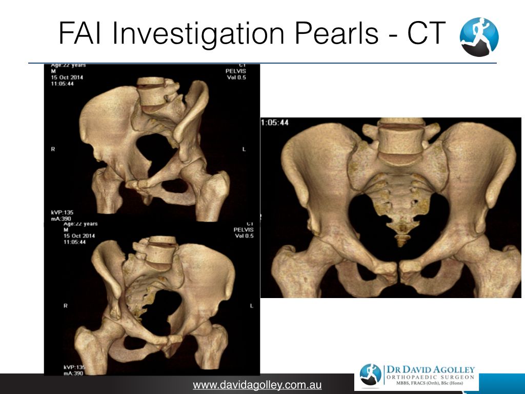 FAI Investigation Pearls - CT | David Agolley Orthopaedic Surgeon