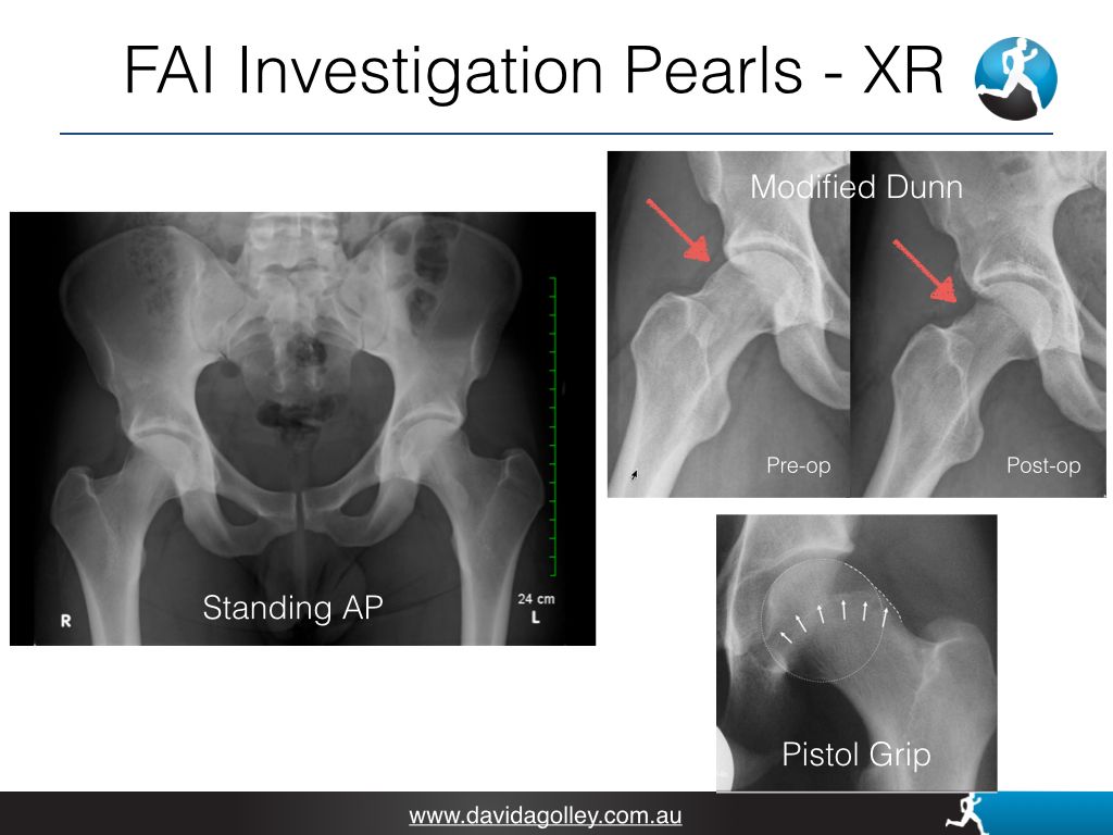 FAI Investigation Pearls - XR | David Agolley Orthopaedic Surgeon