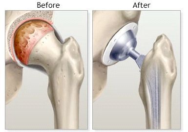 Total Hip Replacement Before & After | David Agolley Orthopaedic Surgeon