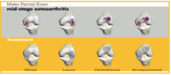 What is the Difference between total and partial knee replacement?  | David Agolley Orthopaedic Surgeon