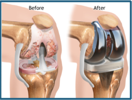 Total knee replacement using robotic assistance  | David Agolley Orthopaedic Surgeon