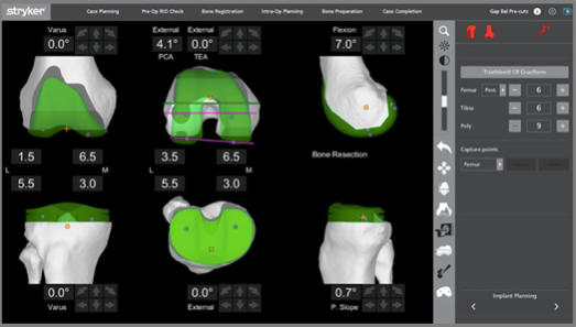 What is involved in Robotic Knee Replacement surgery? | David Agolley Orthopaedic Surgeon