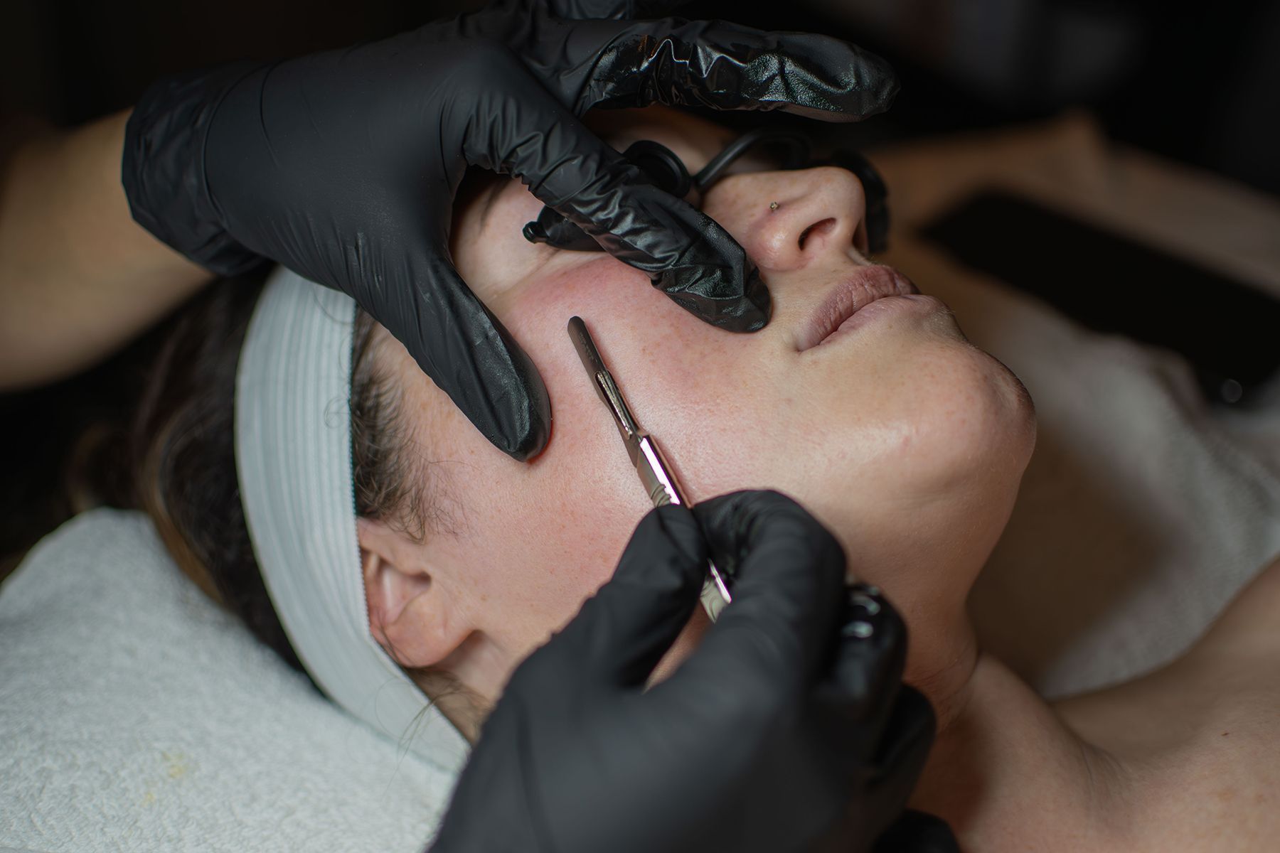 woman receives dermaplane treatment on her face from dermatologist with black gloves