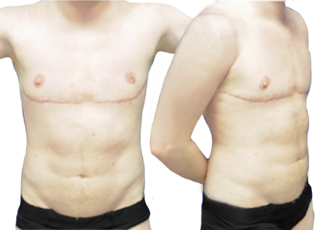 ftm pectoral implants