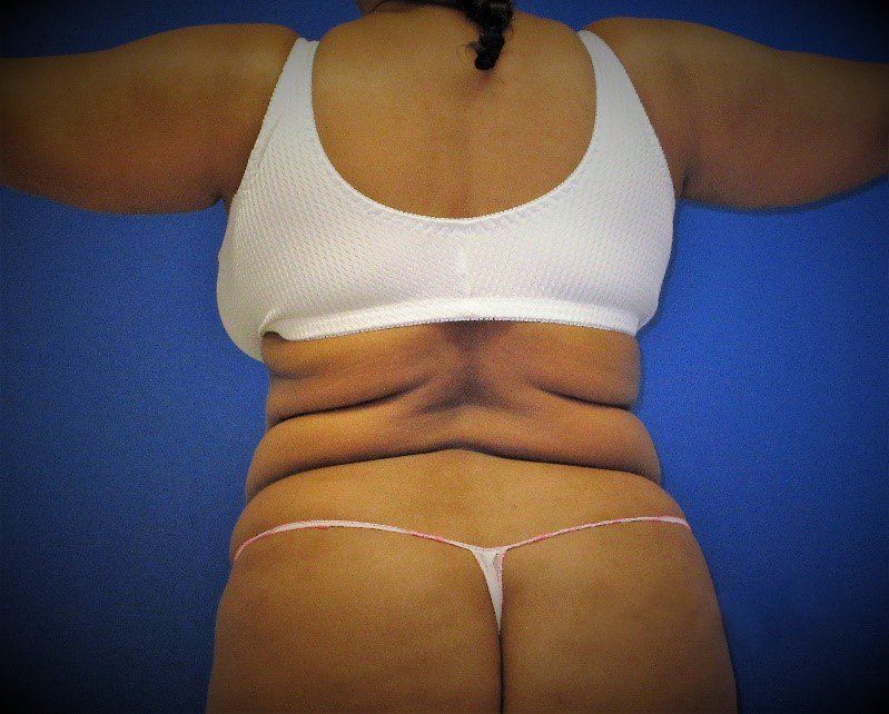a woman's torso before and after surgical body contouring