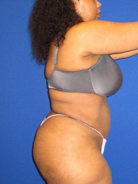 a woman's torso before and after surgical body contouring
