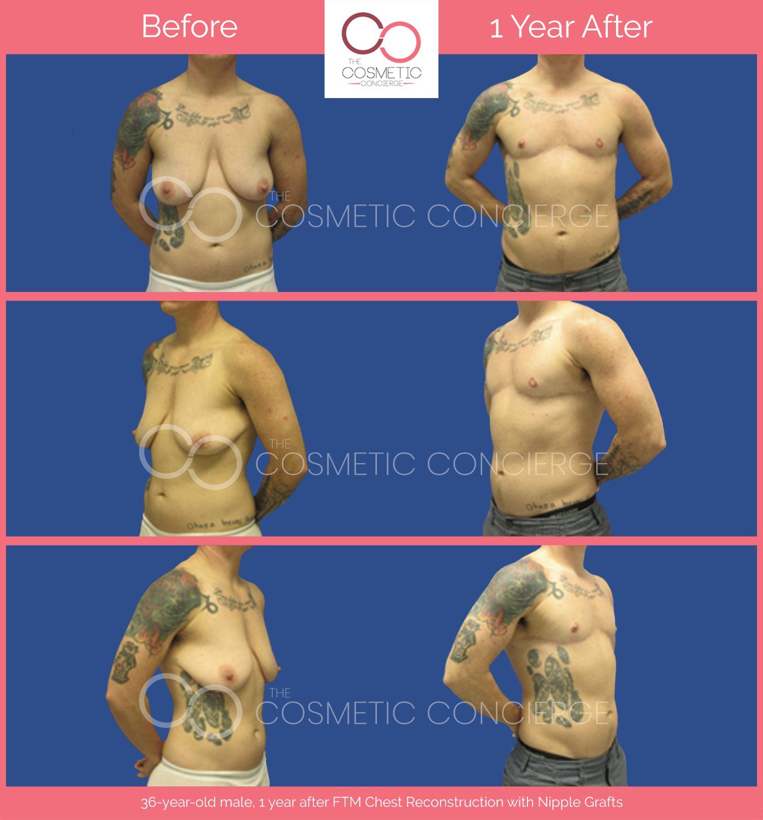 Chest Feminization In Male-to-female Transgender Patients
