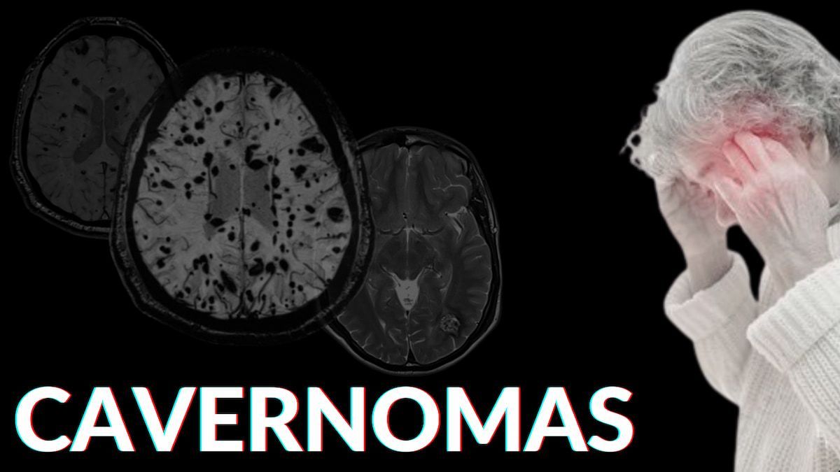 Cavernorma Cerebral