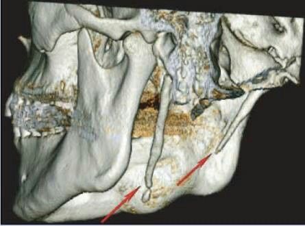 Cirurgia para Sindrome de Eagle