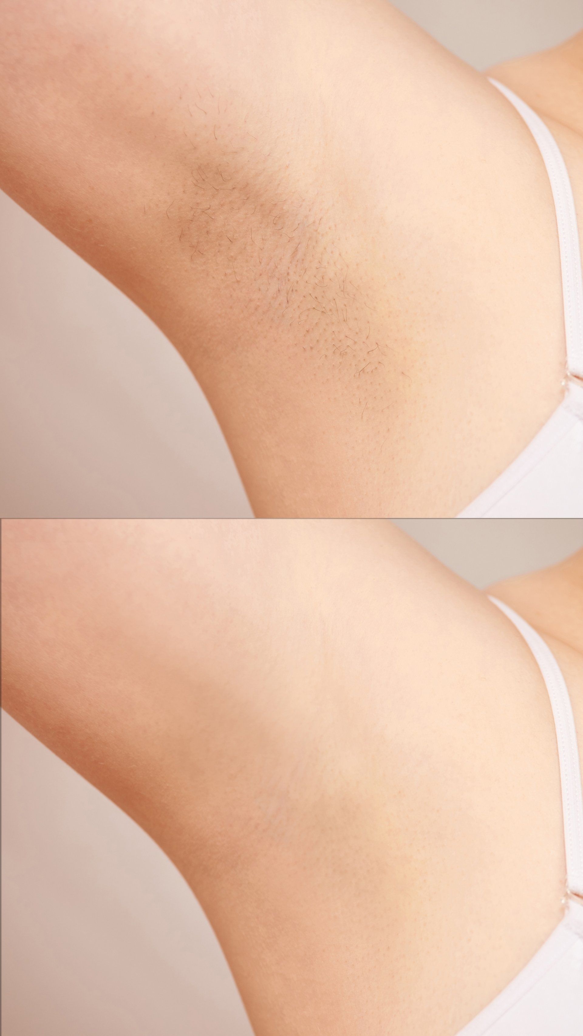 before and after laser hair removal on underarms