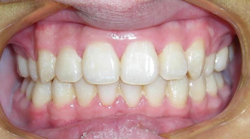 Invisalign Provider — Treated Deep Bite Teeth in Metuchen, NJ