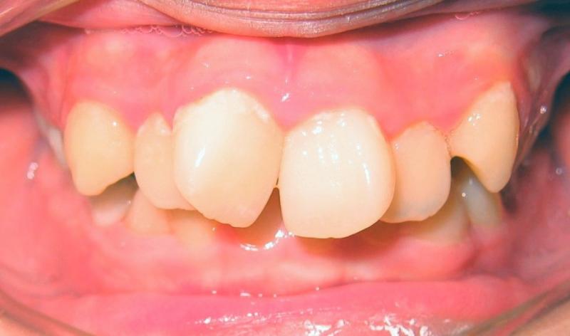 Invisalign — Deep Bite Teeth in Metuchen, NJ