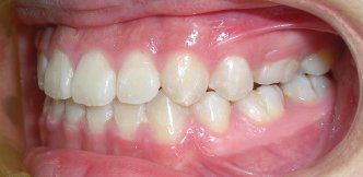 Metuchen Orthodontist — Treated Underbite Teeth in Metuchen, NJ