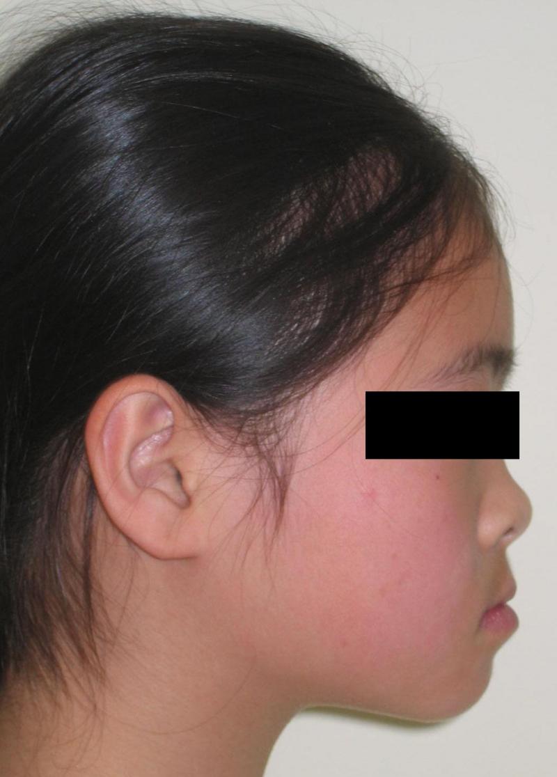 Invisalign Metuchen — Protrusive Profile in Metuchen, NJ