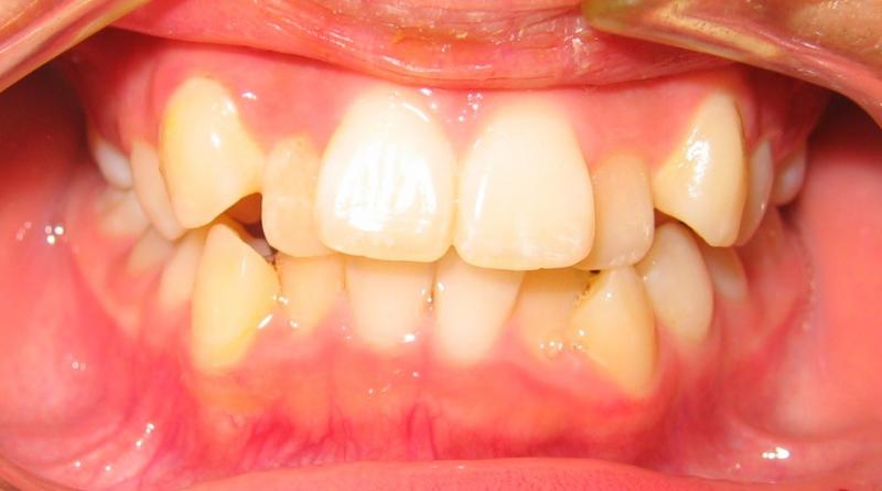 Middlesex County Orthodontist — Sever Crowding Teeth in Metuchen, NJ