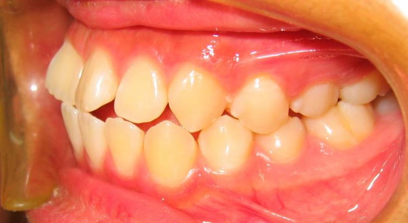 Edison Invisalign — Underbite Teeth in Metuchen, NJ