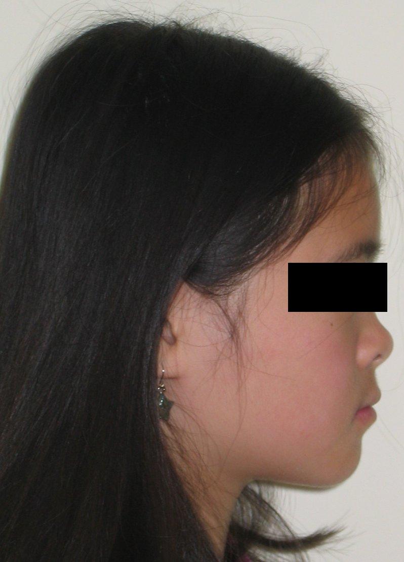 Protrusive Profile — After Teeth Treatment in Metuchen, NJ