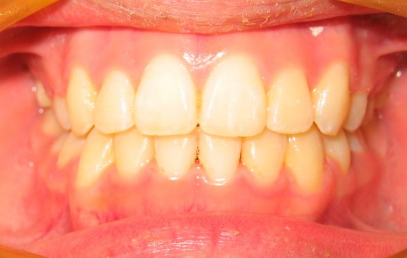 Highland Park Orthodontist — Treated Sever Crowded Teeth in Metuchen, NJ