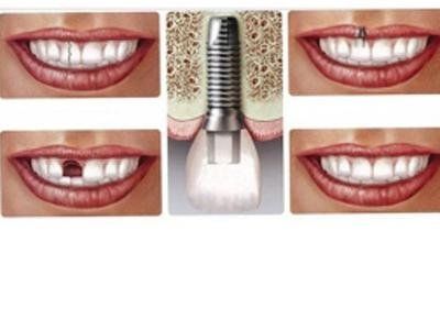 Dental implant