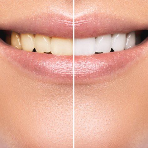 prima e dopo il trattamento di sbiancamento dentale