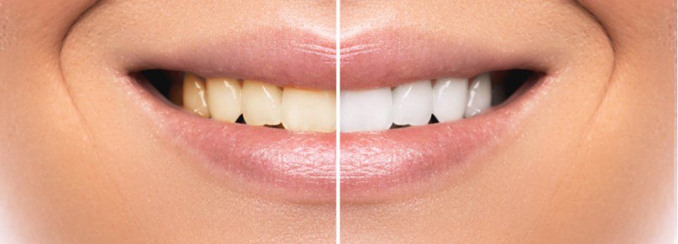 donna prima e dopo il trattamento di sbiancamento dentale