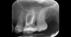 X-rays for endodontics