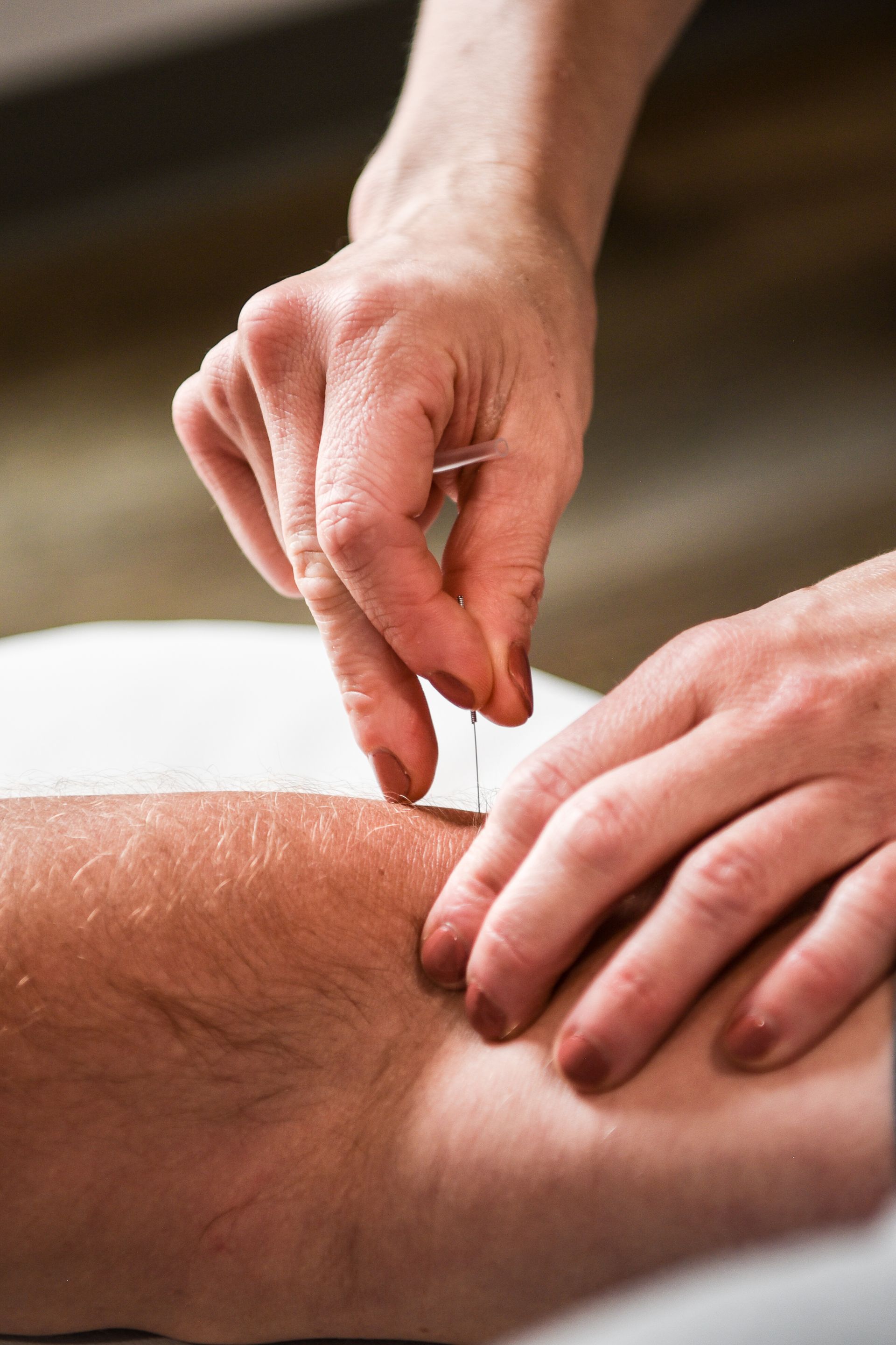 Hands inserting acupuncture needle into a leg.