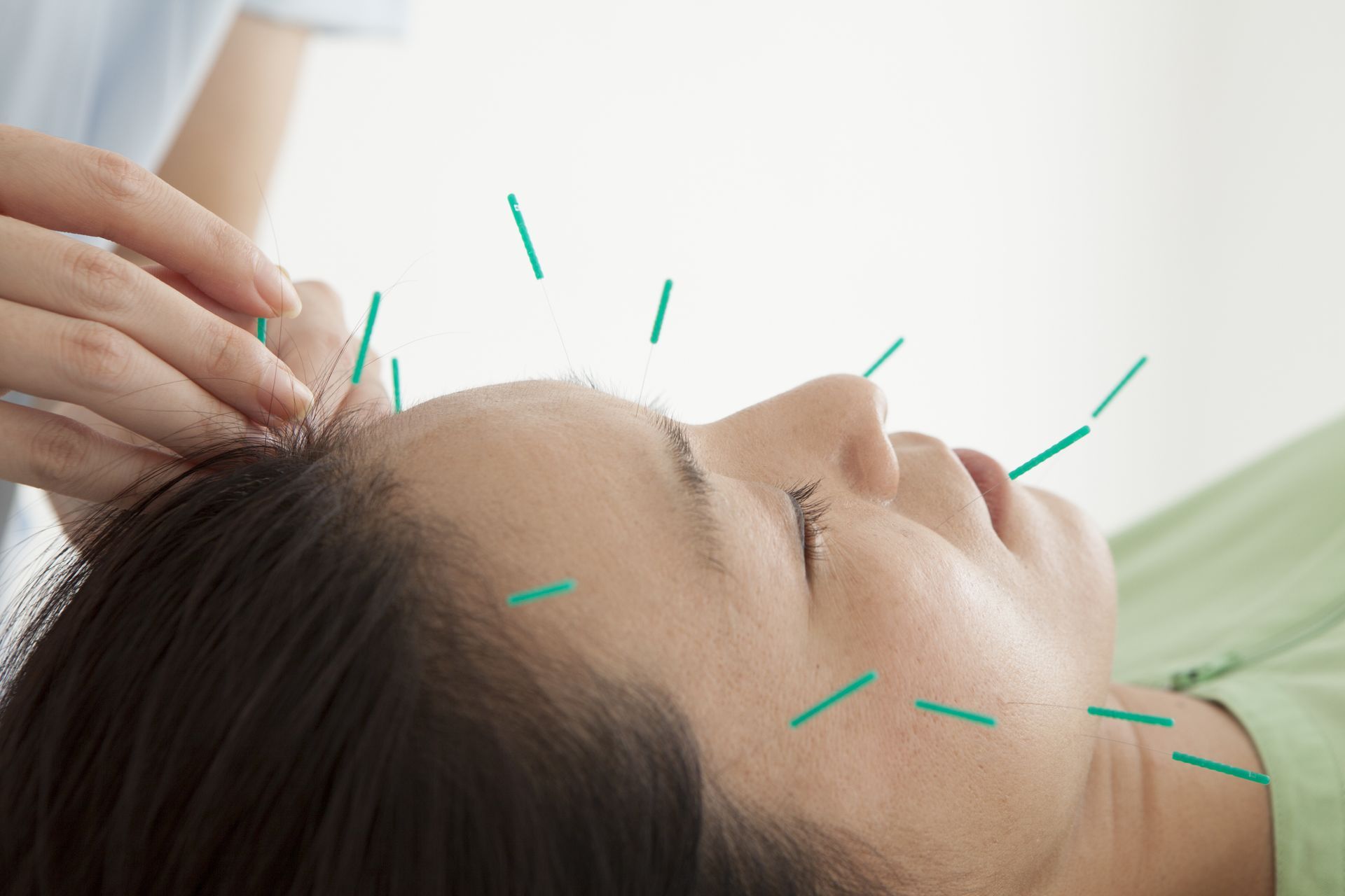 Woman receiving acupuncture on her face and neck. Needles are inserted by hand.