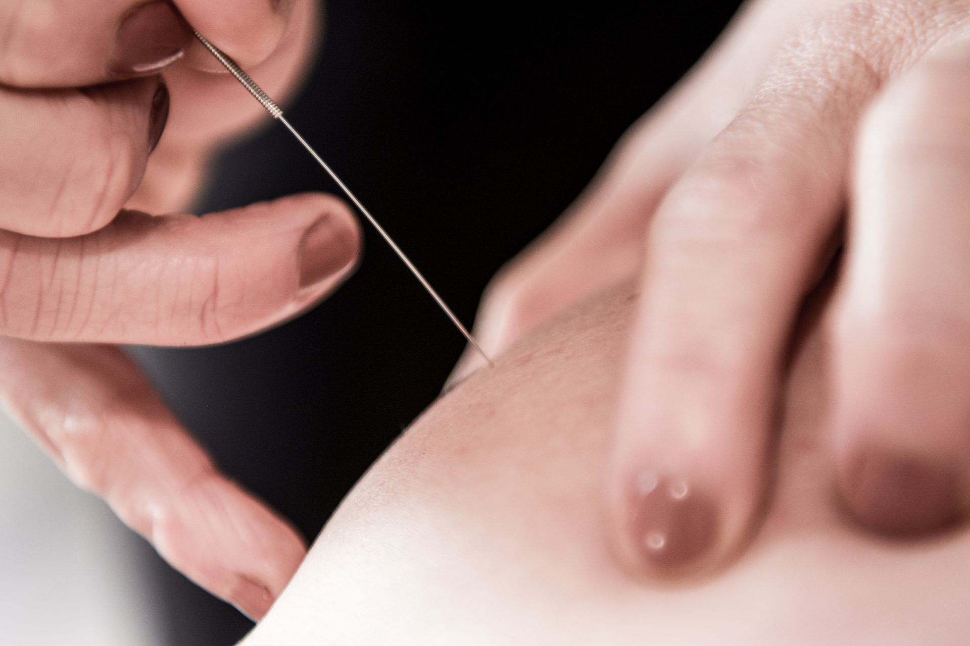 Hands holding a fine needle, performing acupuncture on skin.