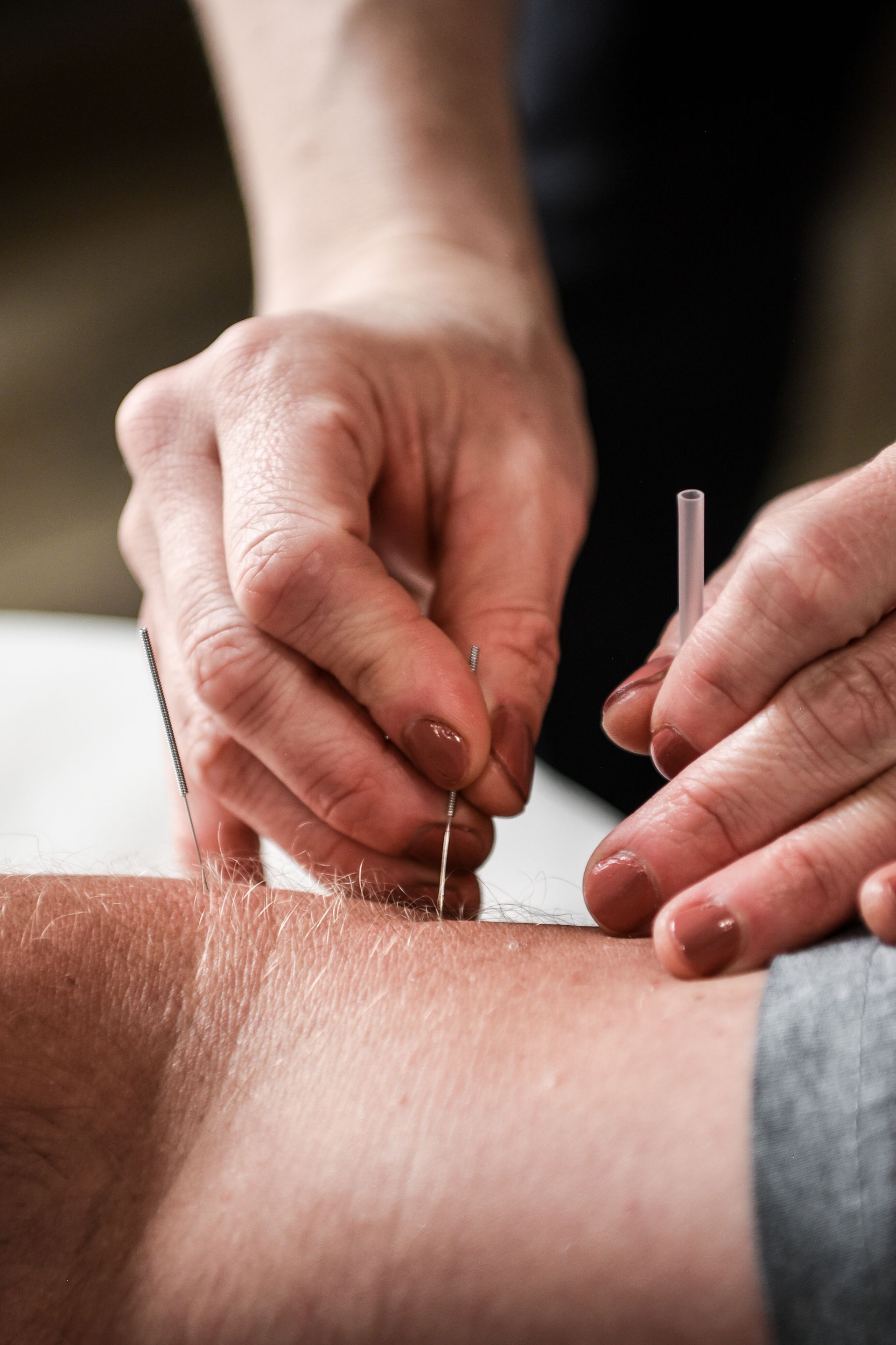 A person's arm receiving acupuncture treatment. Hands hold and insert thin needles into the skin.
