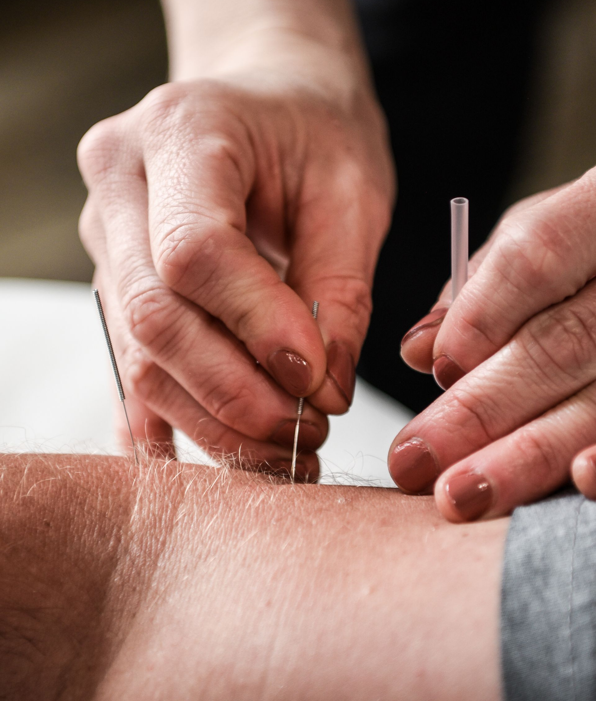 Hands inserting acupuncture needles into a person's arm.