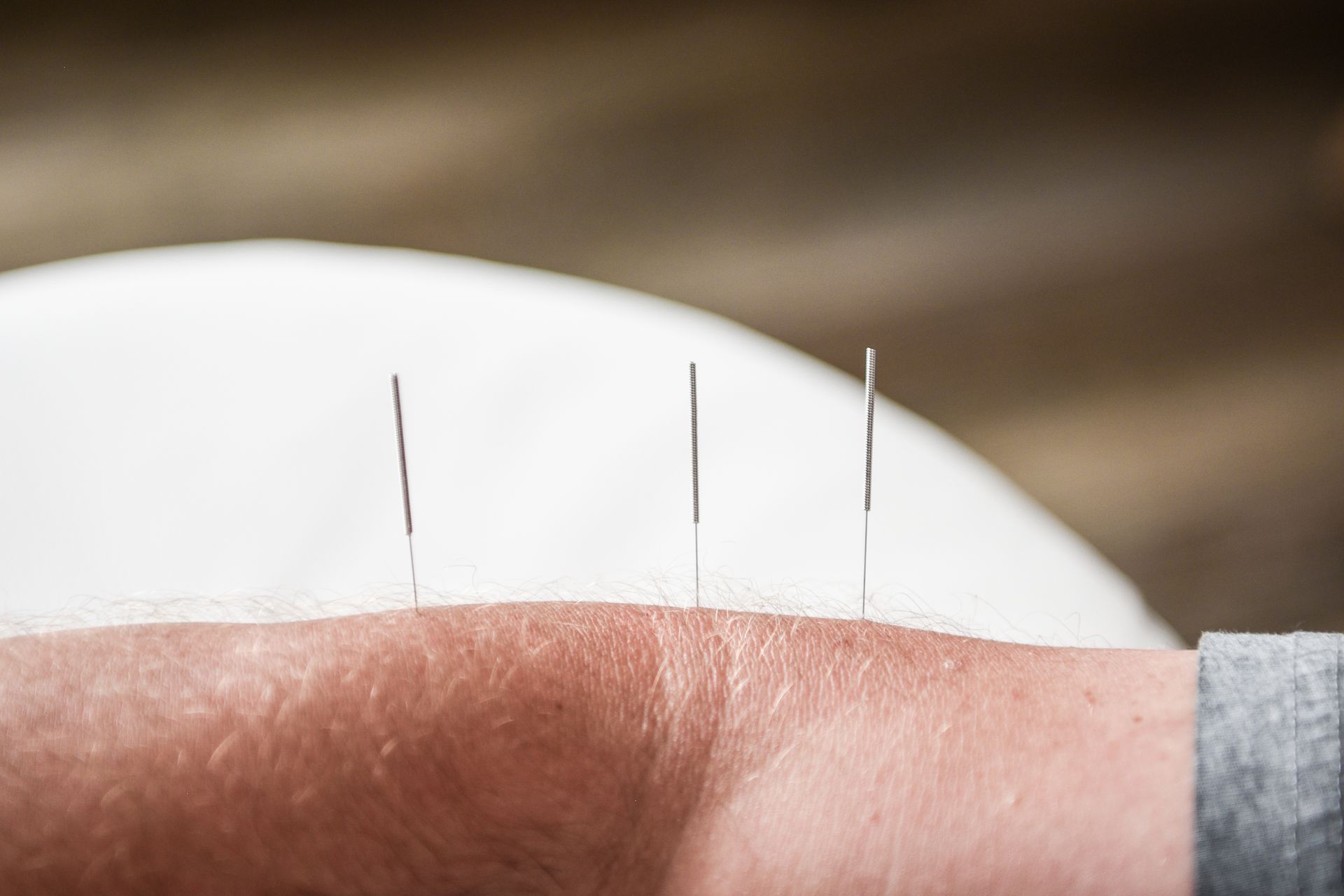 Arm with three acupuncture needles inserted into the skin.