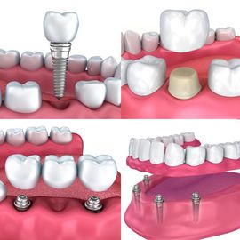 Dental implants example | dentist in Waterford MI