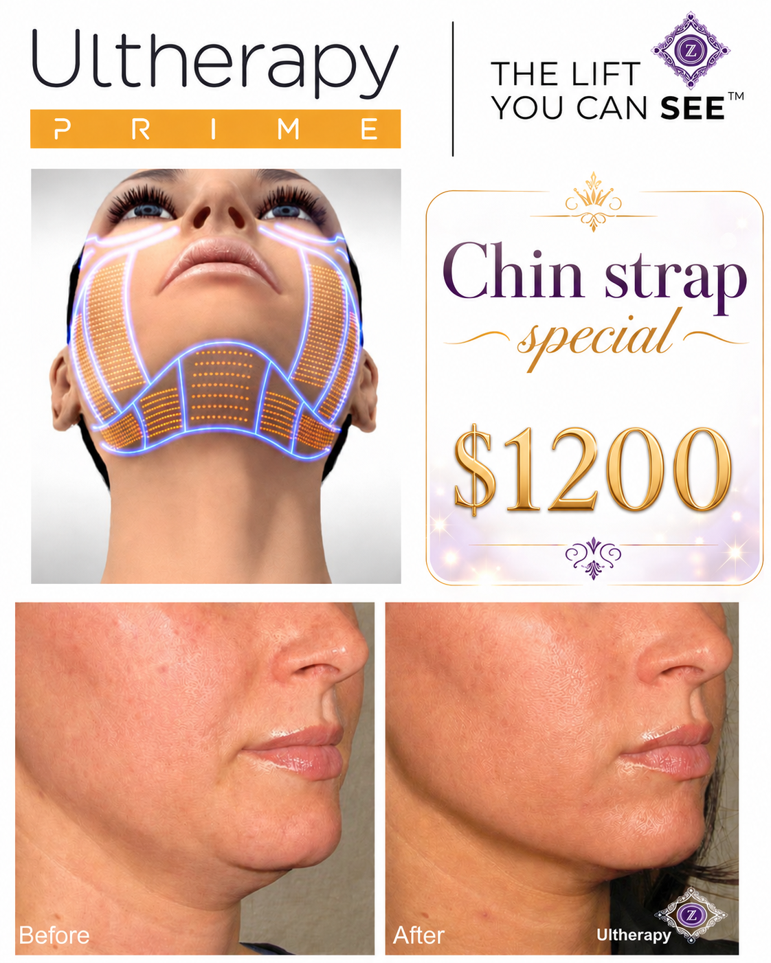 Mothers Day Botox Specials at Z Dermatology in Baton Rouge and Prairieville.
