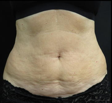 A woman 's stomach is shown with a black background